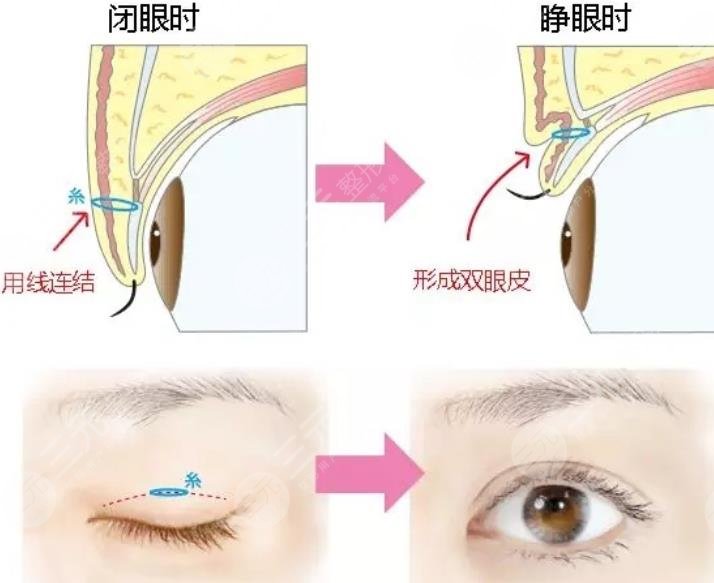 双眼皮整形