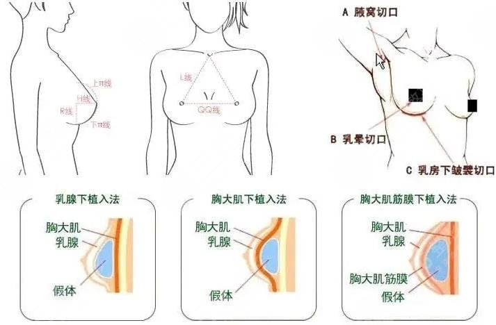 假体隆胸原理