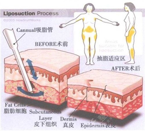 陕西咸阳中医学院附属医院美容科腹部溶脂案例分享