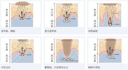 广州华美医疗美容医院激光祛斑案例