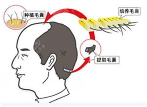 南宁雍禾植发医院发际线种植案例分享