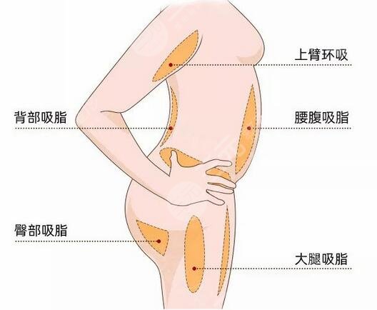 大腿抽脂术后果图