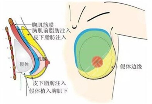 缩胸手术