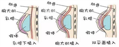 乳房缩小提升术后如何护理