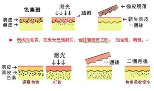 超激光pm祛斑一般几次可以干净