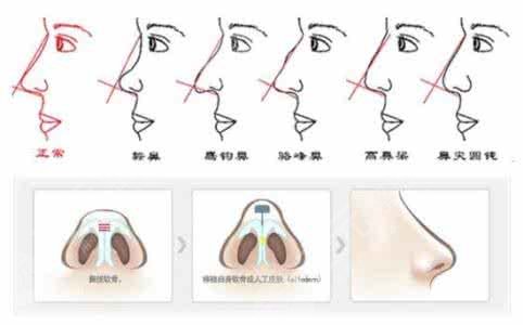 如何改善大鼻头？干货：4个有改善大鼻头的方法