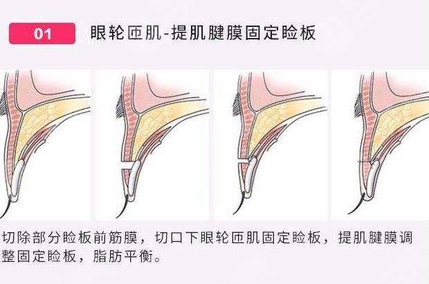 双眼皮整形+开眼角整形原理