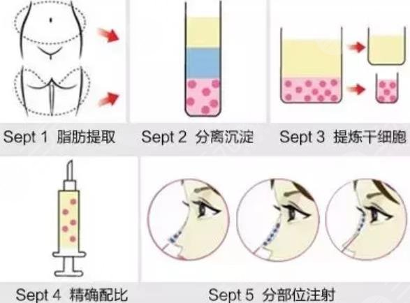 自体脂肪隆鼻原理