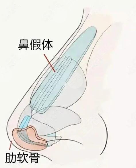 耳软骨隆鼻整形原理