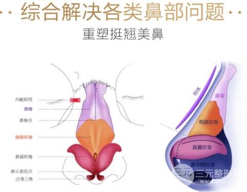 隆鼻整形手术科普