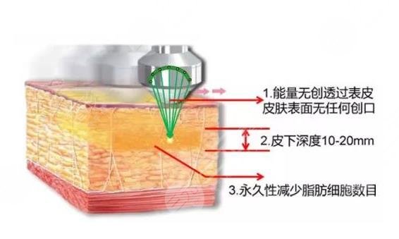 超脂塑溶脂手术面部适应症