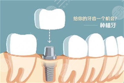 西安瑞泰口腔医院种植牙案例分享