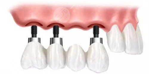洛阳维乐口腔医院种植牙案例分享