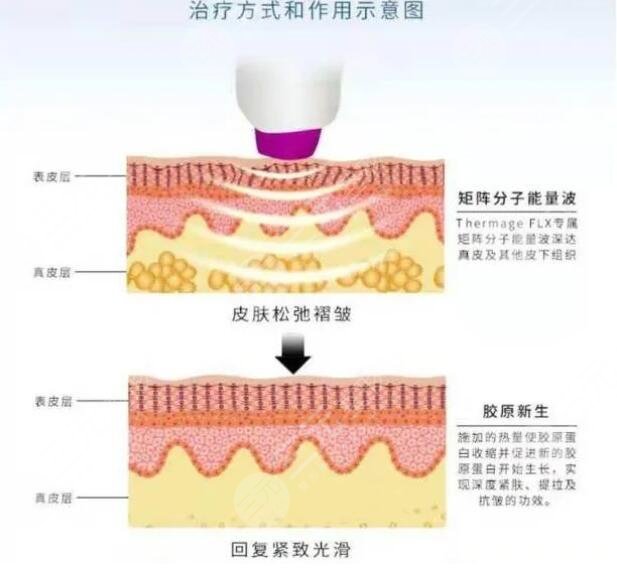 热玛吉的作用原理