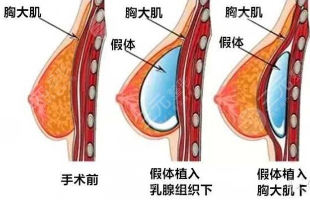 假体隆胸手术的原理