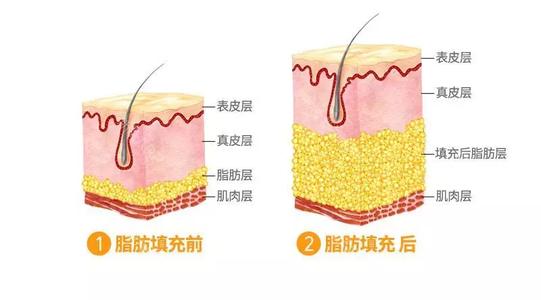 上海脂肪填充手术知识科普