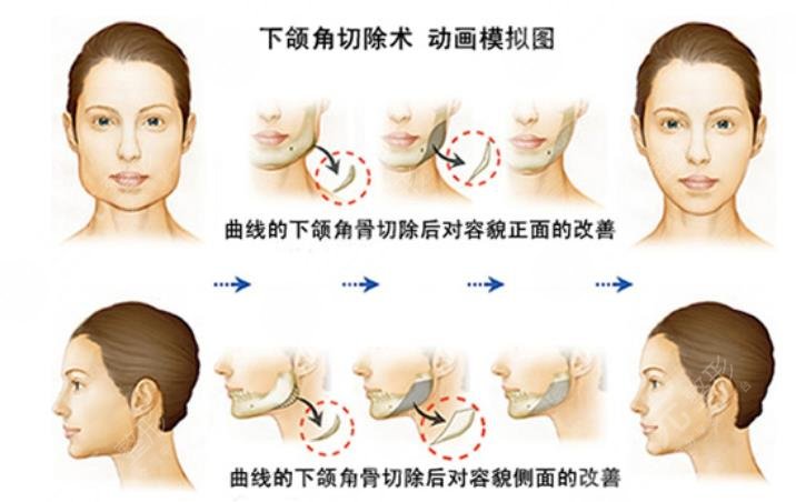 下颌角整形原理