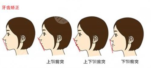 北京劲松口腔医院牙齿矫正案例分享