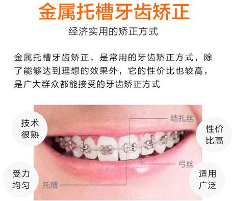 北京劲松口腔医院科普牙齿矫正