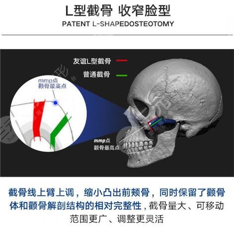 沈绍勇医生颧骨整形知识科普