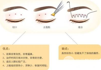 微创双眼皮多久恢复自然