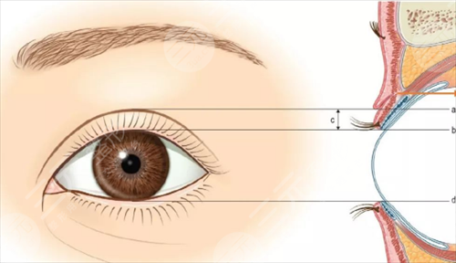 眼皮松弛怎么办？爱美者一定要引起足够的重视！