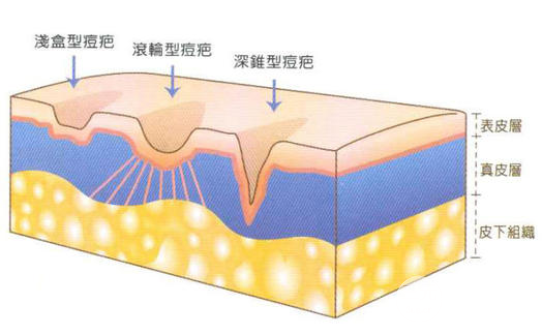 痘印痘疤