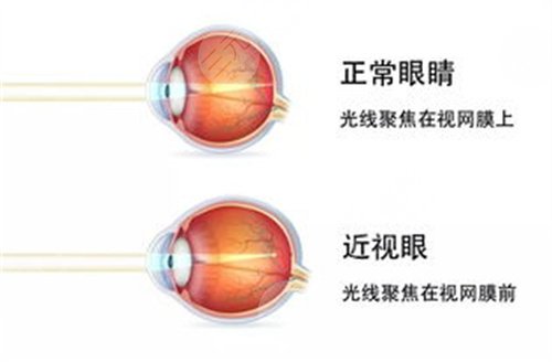 近视眼的患者应该做好眼球突出的预防工作