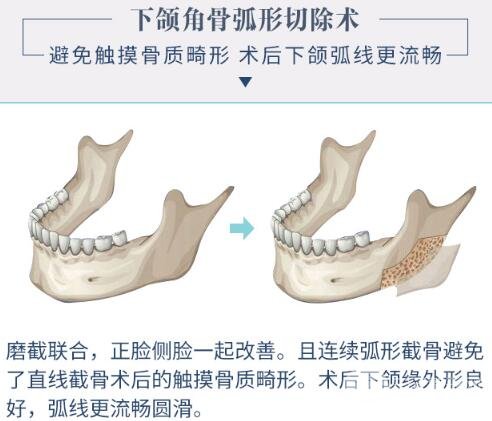 明星喜欢的整容手术