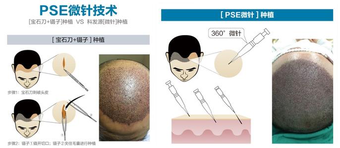 国内植发机构碧莲盛科普