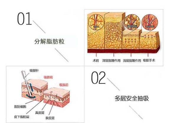 抽脂对手臂有什么影响?