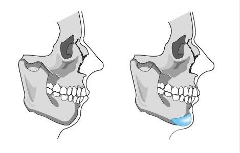 人工下巴植入假体术
