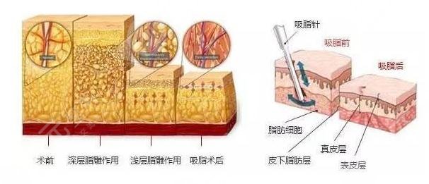 什么是面部吸脂