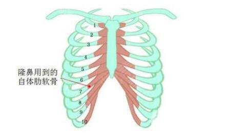 肋软骨隆鼻手术恢复期多久?