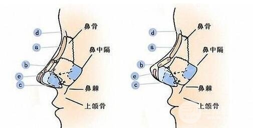 膨体隆鼻手术后的注意事项