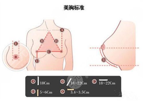 假体隆胸案例术后3个月