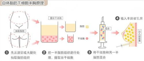 北京艺美整形面部脂肪填充案例