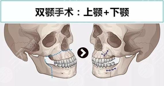 双颚手术