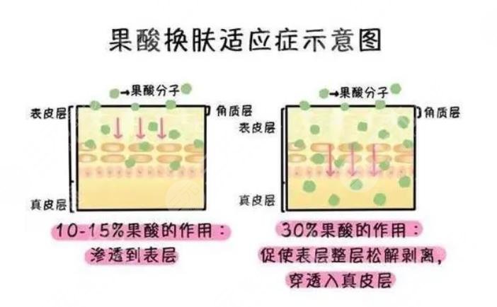 果酸换肤