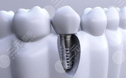 种植牙多少钱一颗2021价格表北京地区，这4个原因都影响了种植牙收费