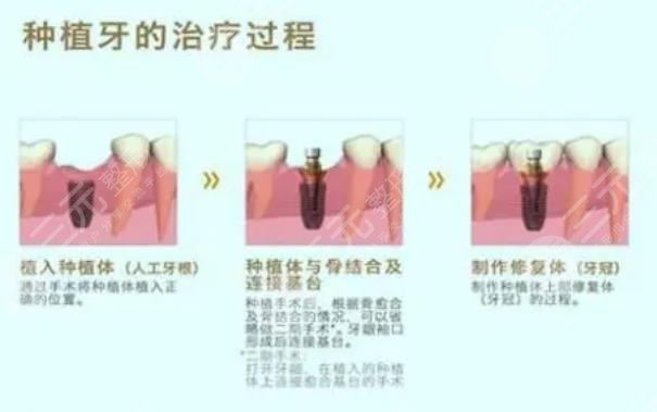 牙齿种植术