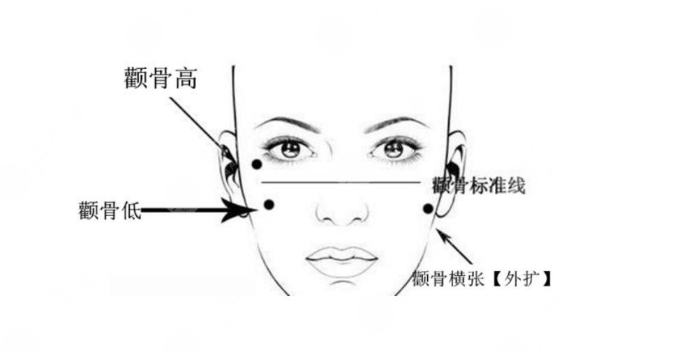 什么是颧骨整形术