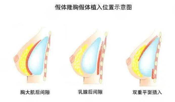 假体隆胸都有哪些优点