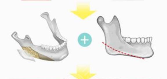 下颌角截骨都有哪些好处?