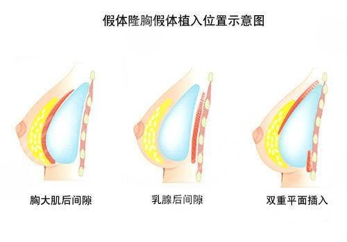 假体隆胸有哪些优点?