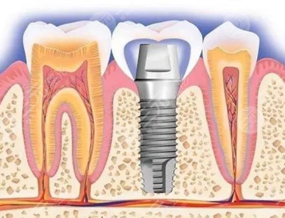 牙齿种植原理