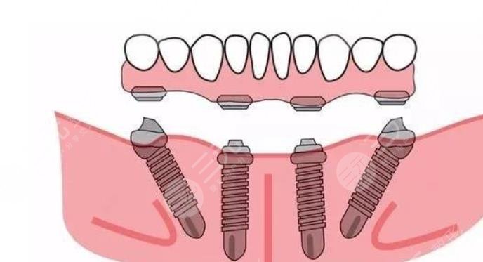 牙齿种植原理