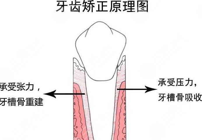 牙齿矫正原理