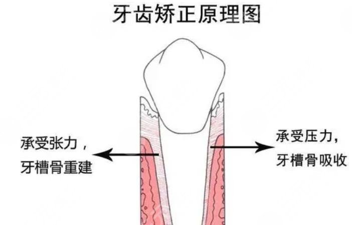 牙齿矫正原理