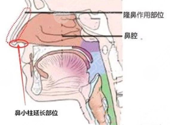 鼻小柱整形